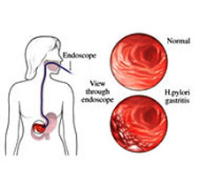 gastritis