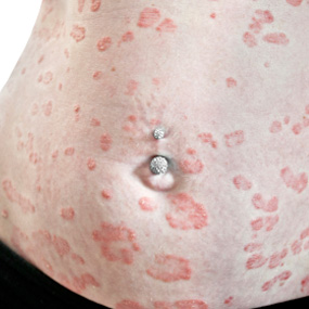 guttate psoriasis treatment in homeopathy