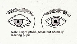 horner's syndrome