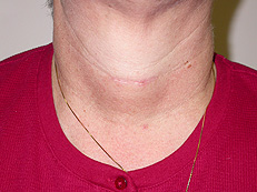 lithium-induced goiter