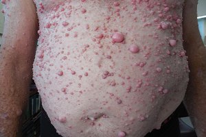 neurofibromatosis