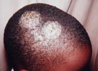 tinea capitis