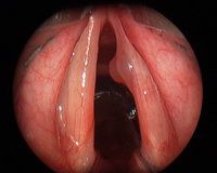 vocal cord polyp