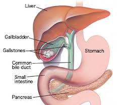 gall bladder stone gallstones