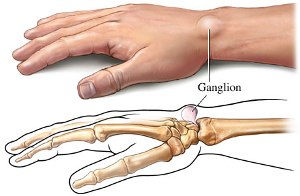ganglion cyst