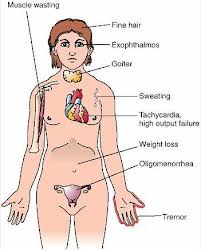 hypothyroidism