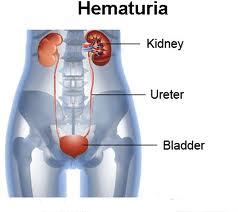 hematuria