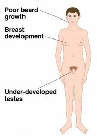 klinefelter syndrome