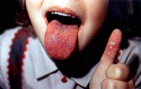 hand foot mouth disease hfm