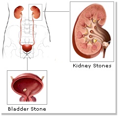 Urinary Bladder Stones