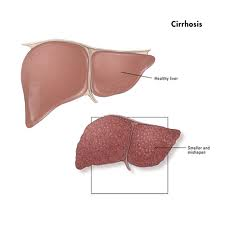 Cirrhosis of liver