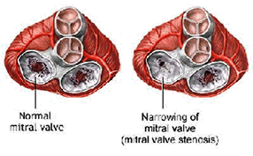 mitral stenosis