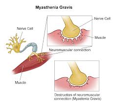 Myasthenia Gravis