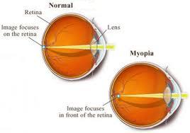 myopia