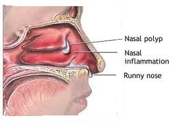nasal polyp