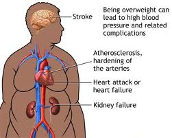 Homeopathic_doctor_chandigarh_obesity