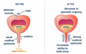 overactive bladder