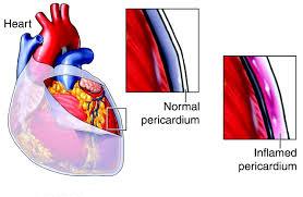 pericarditis