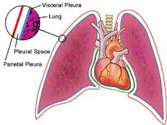 pleurisy