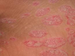 psoriasis