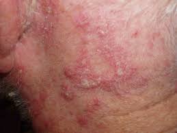 Seborrhoeic Dermatitis