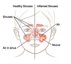 sinusitis