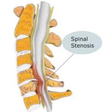 spinal stenosis