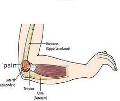 tennis elbow