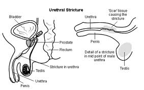urethral stricture