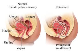 uterine prolapse