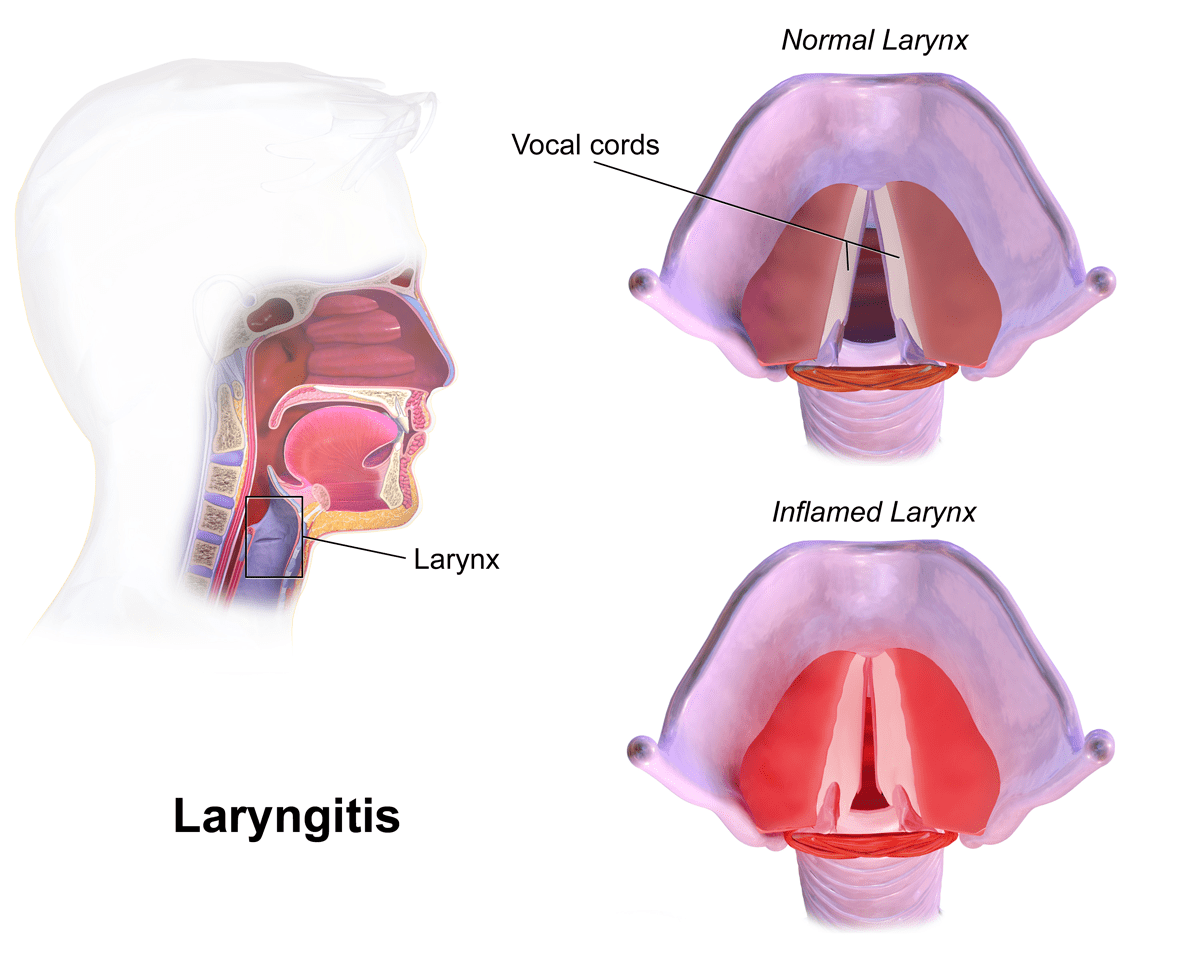 about laryngitis