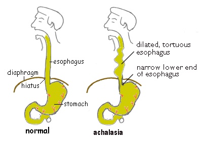 achalasia