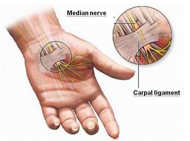 carpal tunnel syndrome