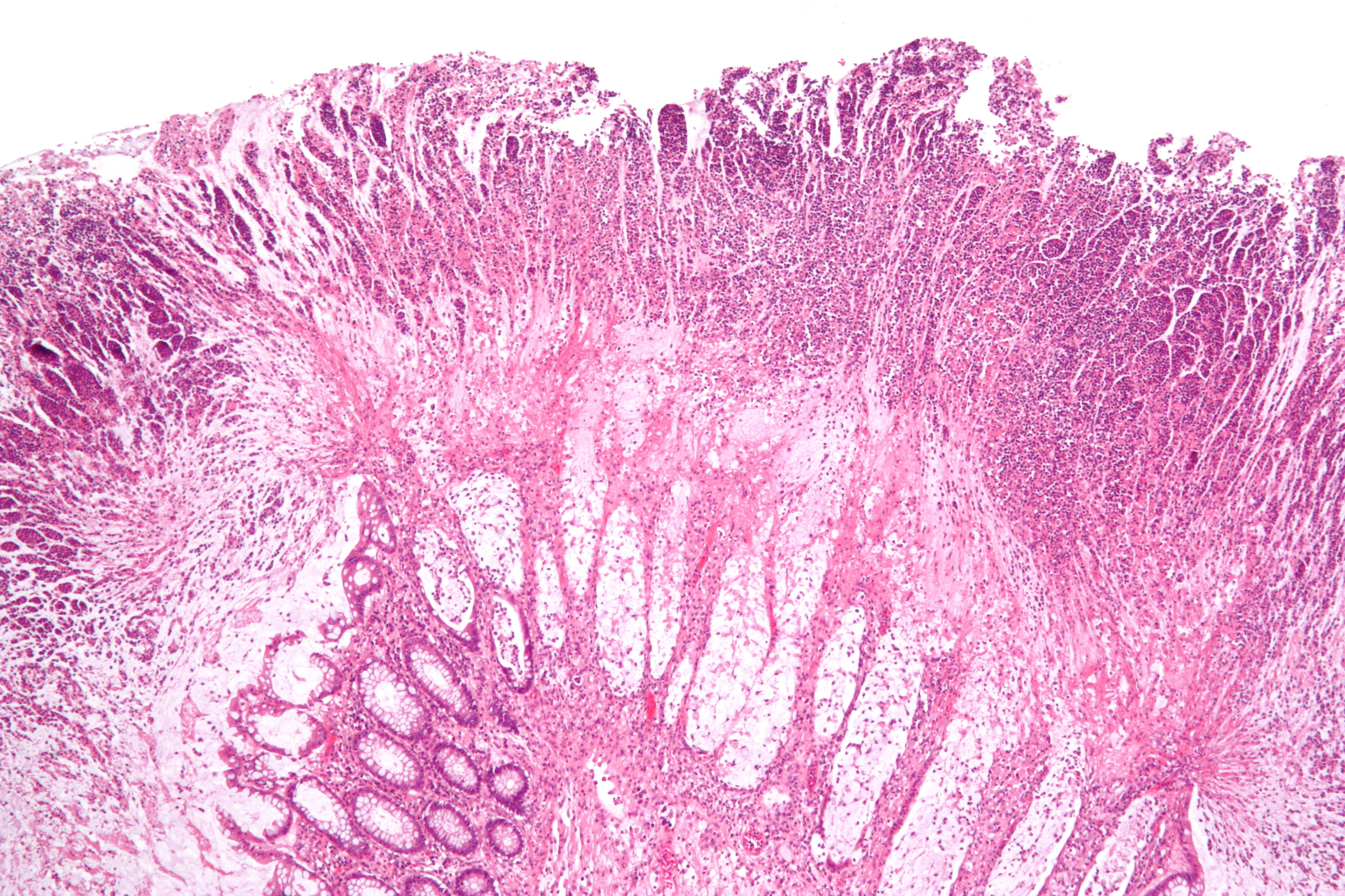 history of clostridium difficile colitis icd 10