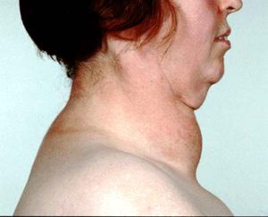 diffuse toxic goiter