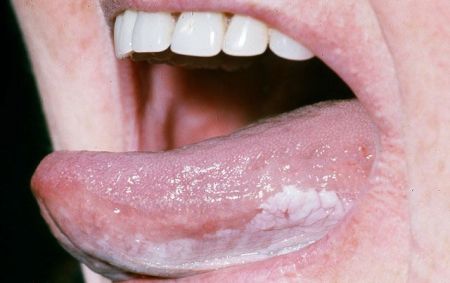 Oral Leukoplakia