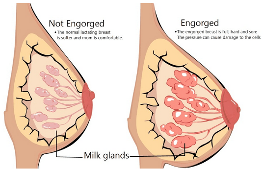 Common Treatments for Breast Engorgement, Blocked Milk Ducts & Mastitis