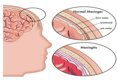 meningitis