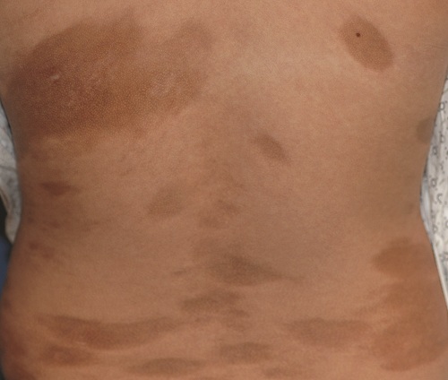 morphea-skin-disease