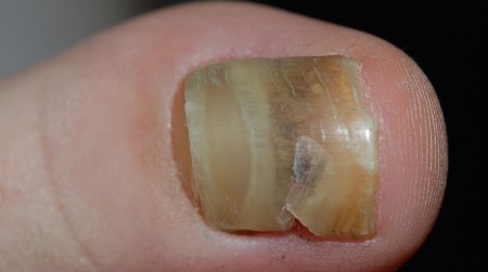 Onychomycosis/ Nail Fungus | Dr. Thind
