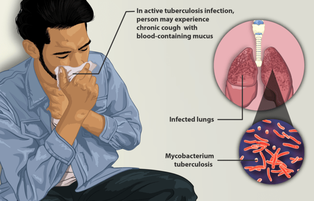 tuberculosis