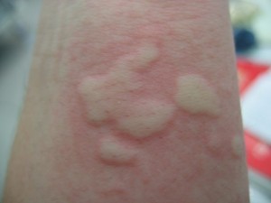 urticaria