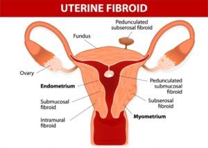 uterine fibroids