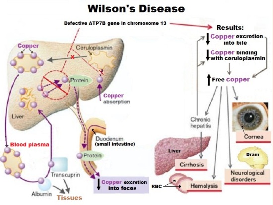 wilson disease