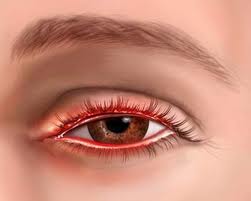 blepharitis