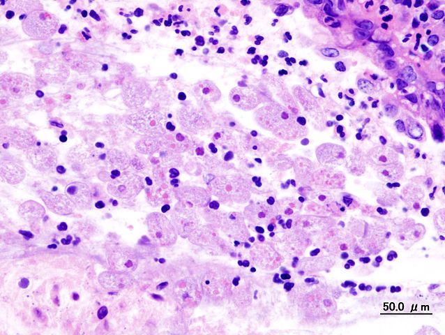 Amoebic Dysentery | Causes, Symptoms &amp; Treatment