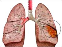 lung abscess