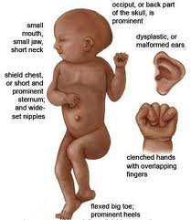 Edward Syndrome (Trisomy 18)