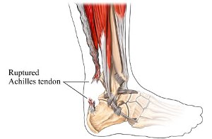 Achilles tendon rupture