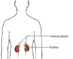 conn syndrome